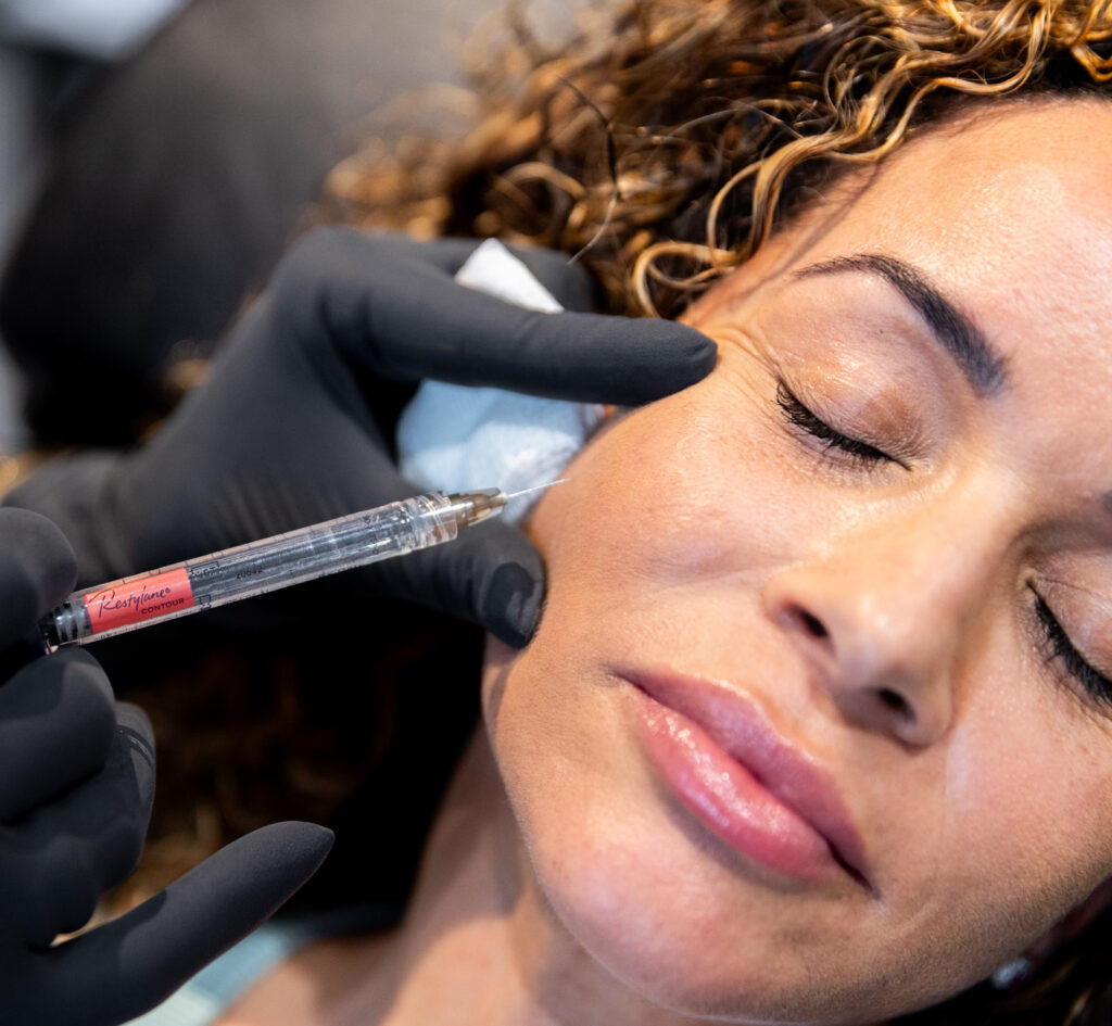 A woman is receiving dermal filler in Newburgh, NY, to accentuate her cheekbones.